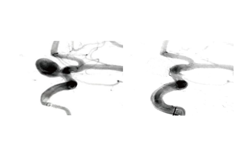 The first loop is designed at 75 of the nominal diameter, significantly reducing the risk of coil pr...