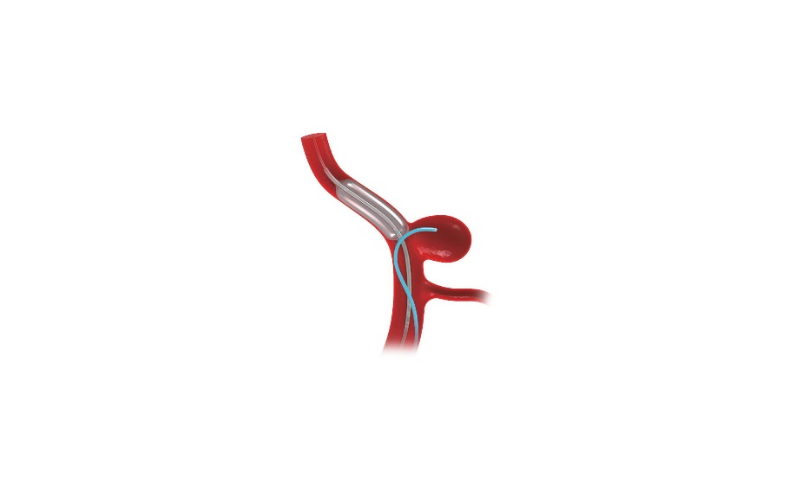 ifanyi classWhen the flow diverter shows incomplete expansion or poor wall apposition, Utility enabl...