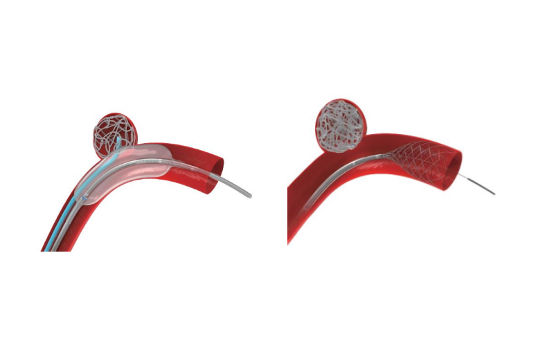 tion Compatible with DMSO. The balloon blocks the proximal vessel to prevent reflux during embolic a...