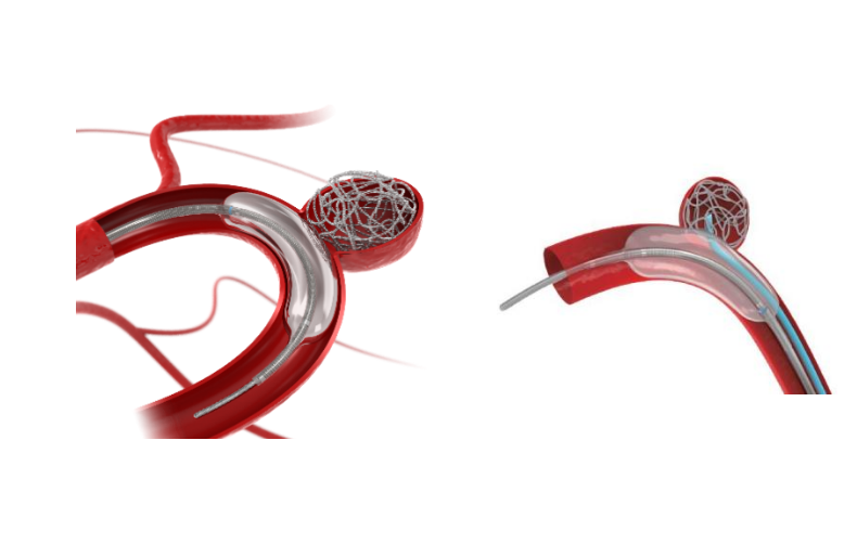 Our coils feature a reliable onesecond rapid detachment mechanism, helping shorten procedure time an...