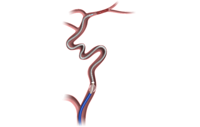 Acute ischemic stroke (AIS)