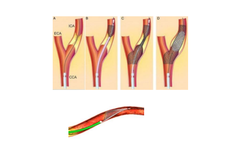 Our portfolio includes Embolic Protection Devices EPDs, which are widely recommended in endovascular...