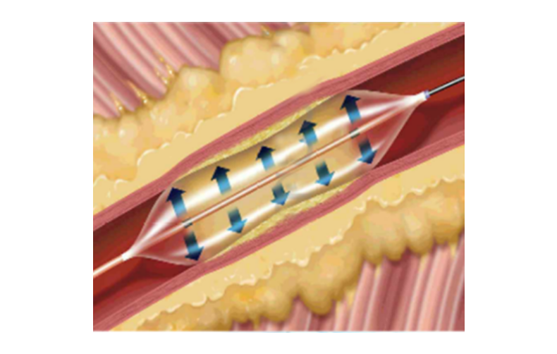 TJWY Medical provides specialized solutions for ICAS treatment, including rapidexchange intracranial...