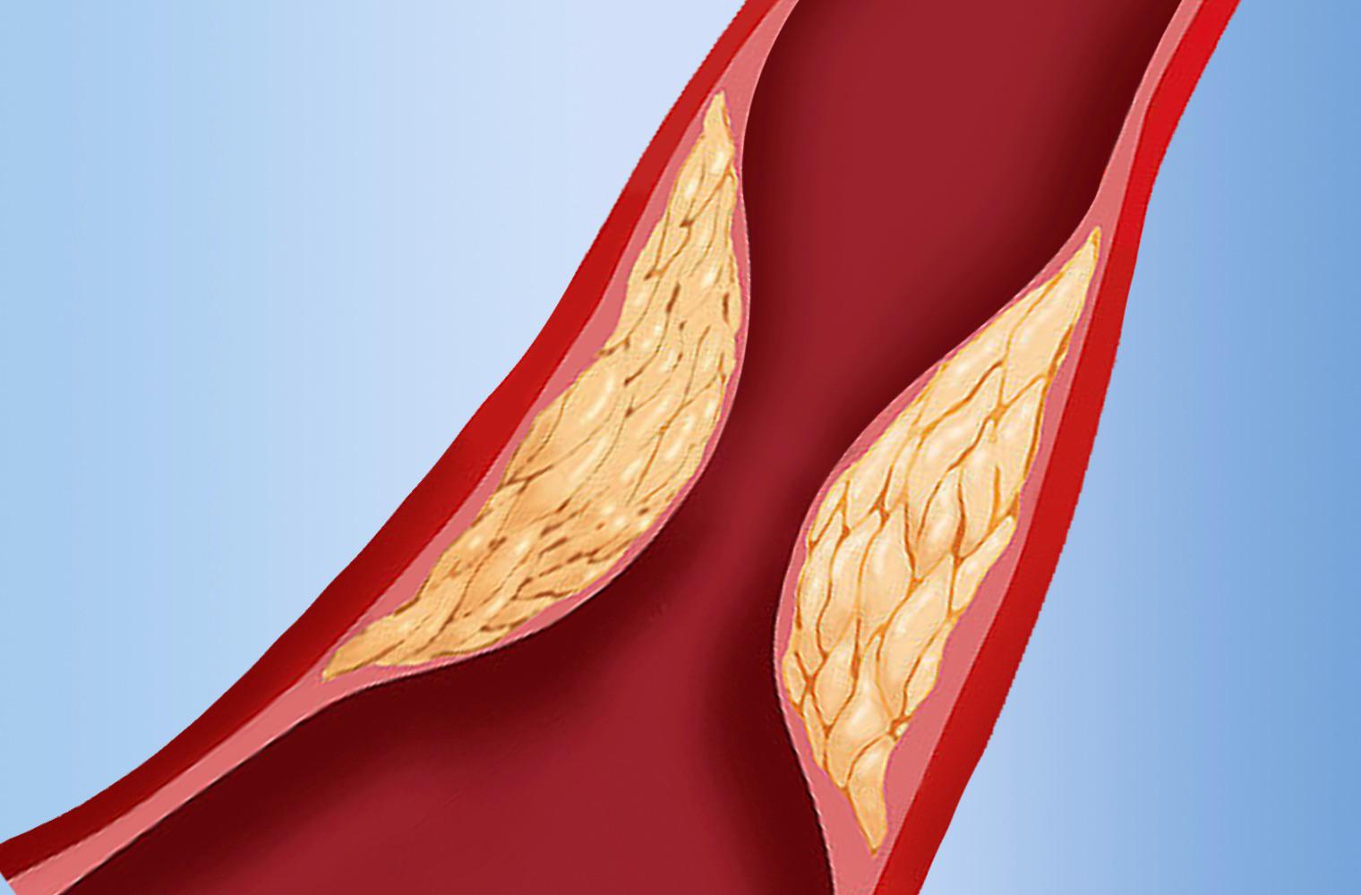 Intravascular stenosis