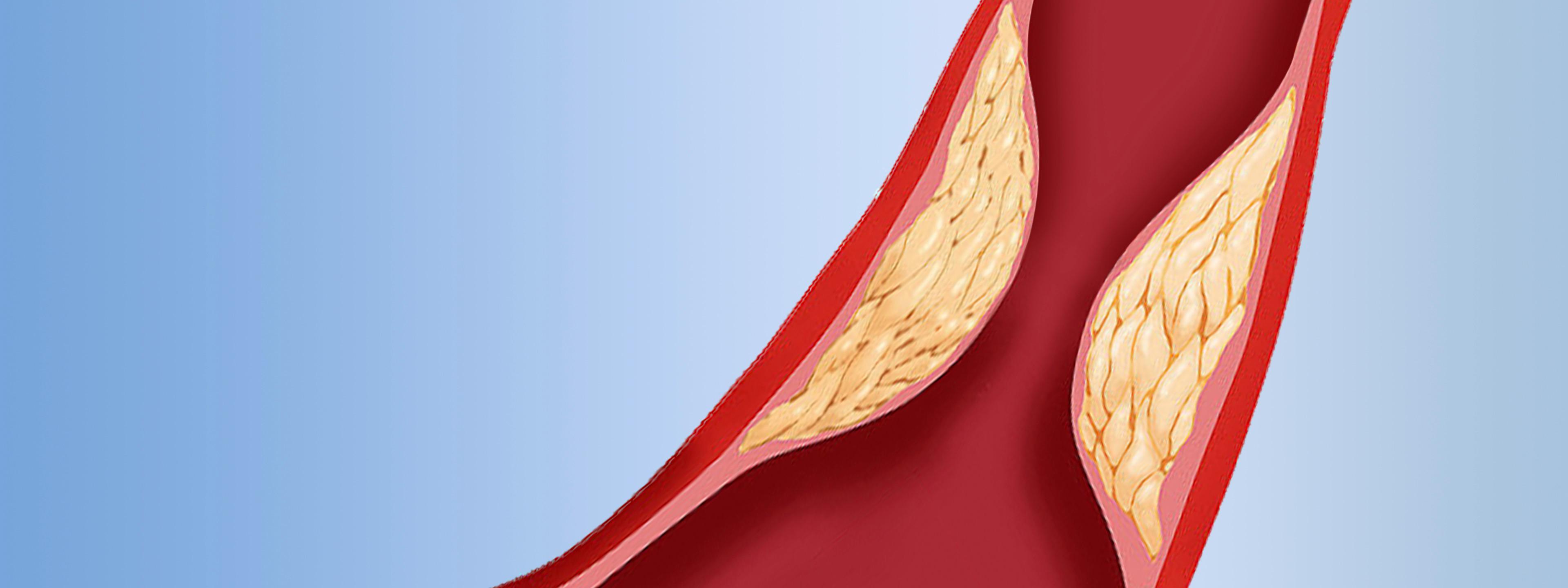 Intravascular Stenosis Solutions