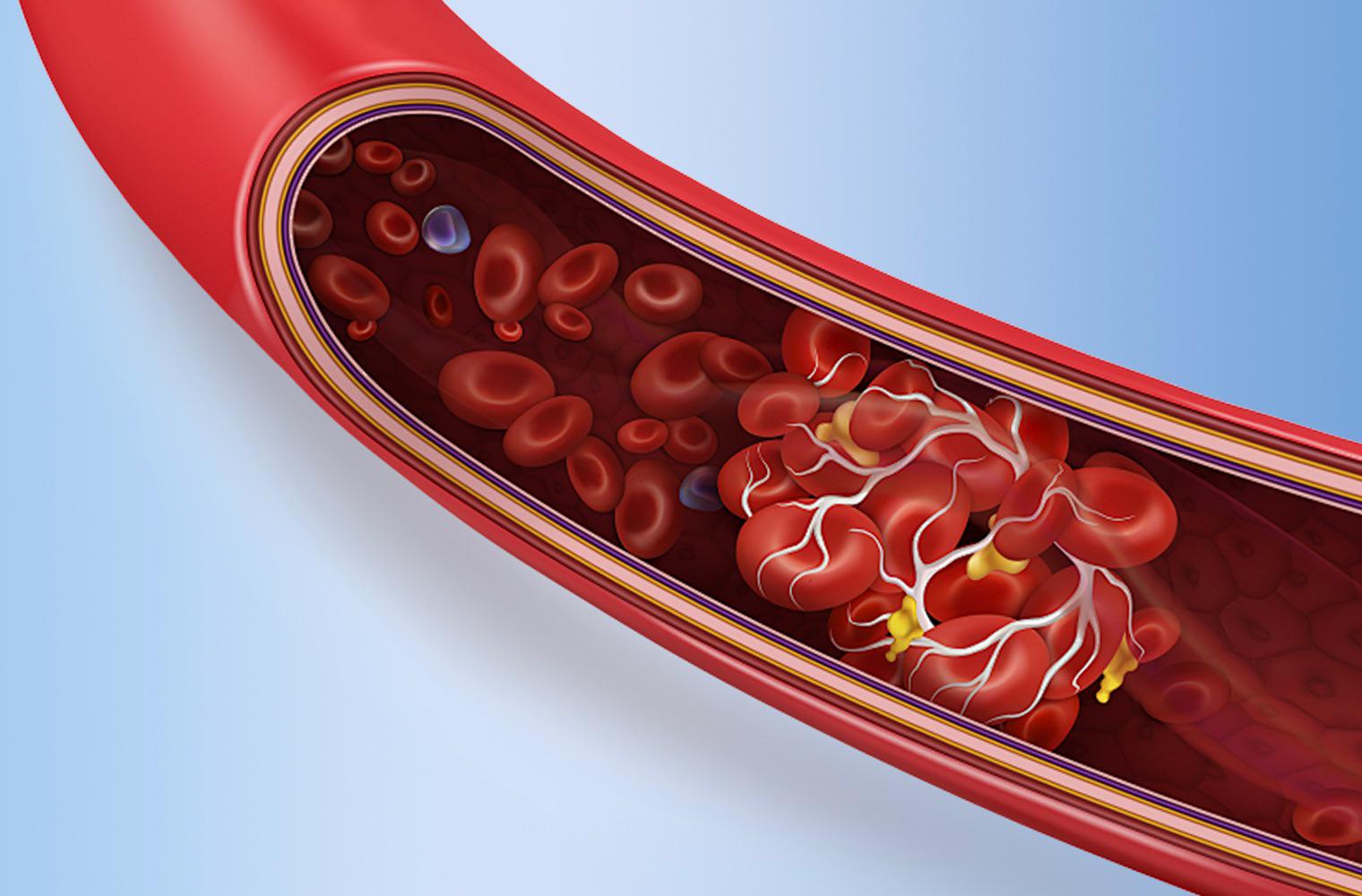 Acute Ischemic Stroke