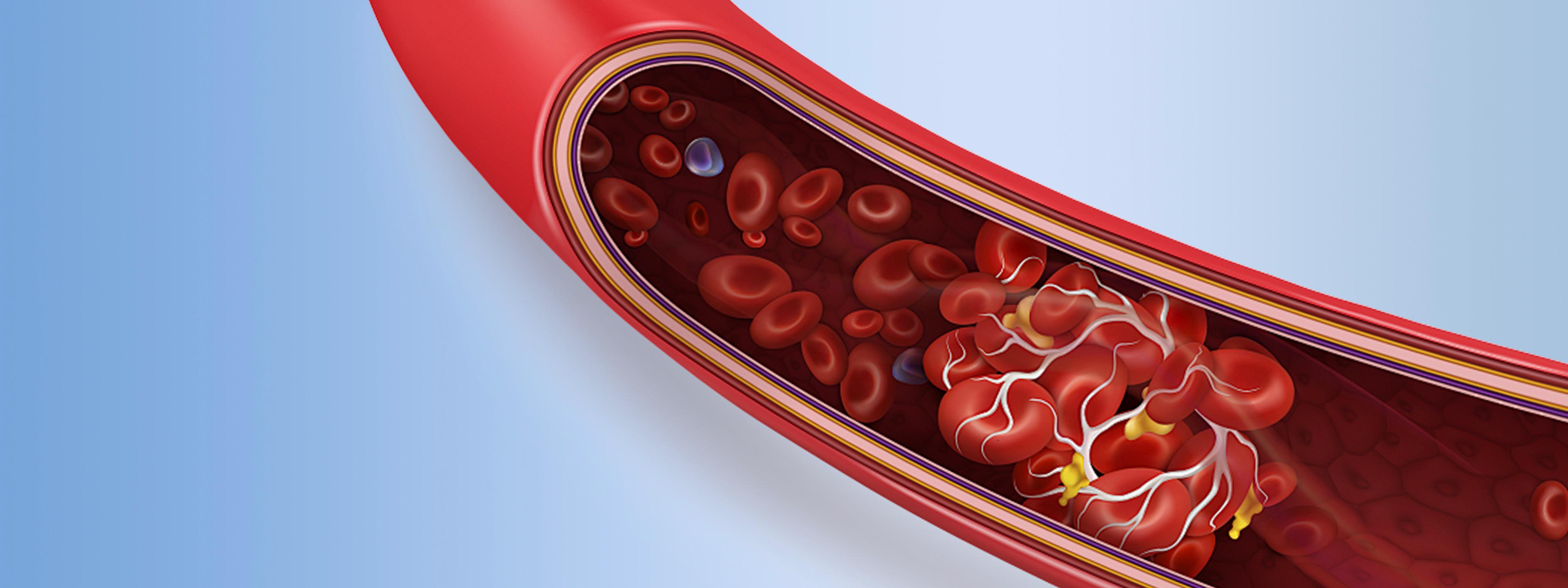 Acute Ischemic Stroke Solutions