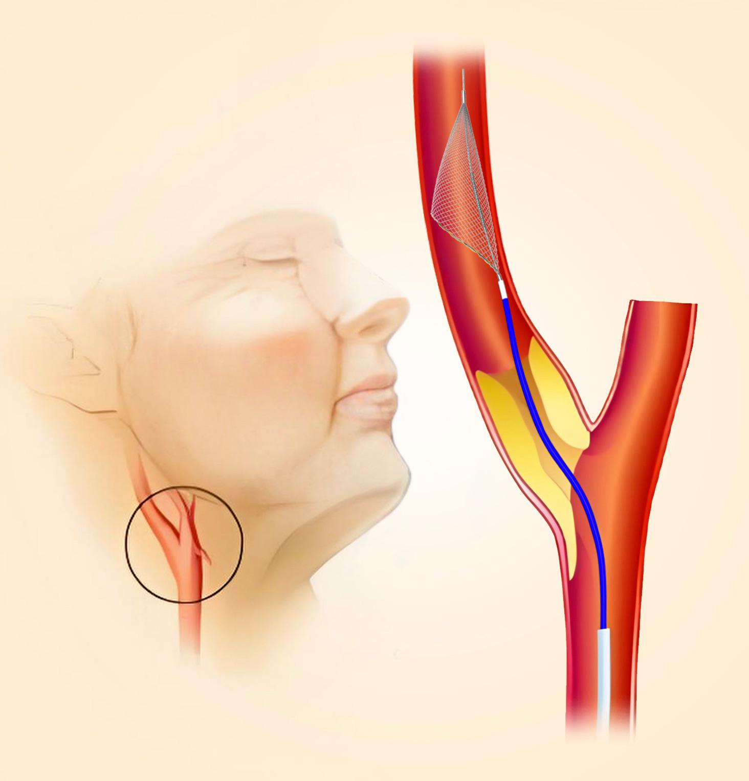 Carotid Artery Stenosis