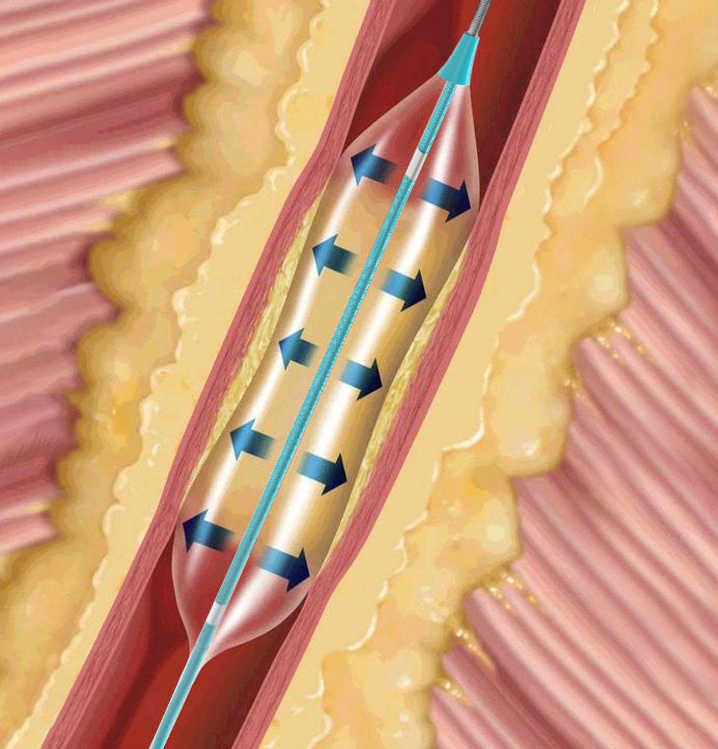 Intracranial Atherosclerotic Stenosis